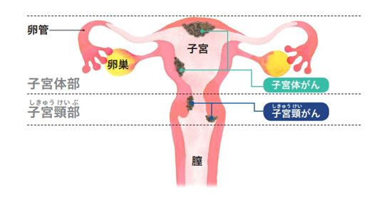 子宮体がんと子宮頸がんの発症箇所