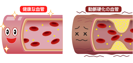 健康な血管と、動脈硬化になった血管のイメージ