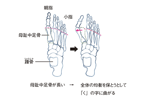 足の骨格の構造と崩れ