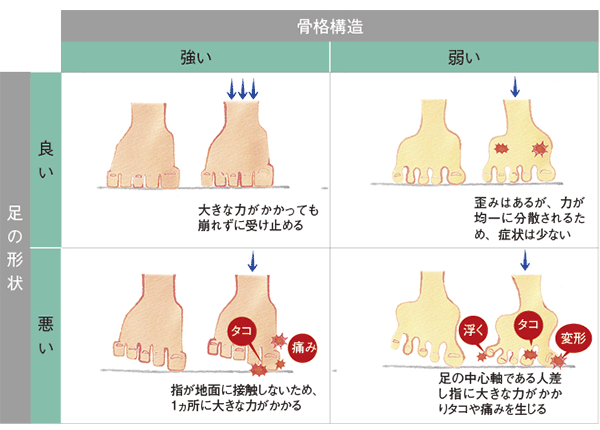 足の骨格構造・形状の違いによる影響