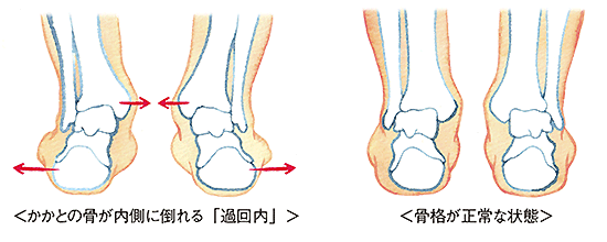 骨格が歪んだ状態の比較