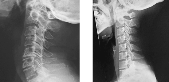 左：正常頸椎、右：ストレートネック