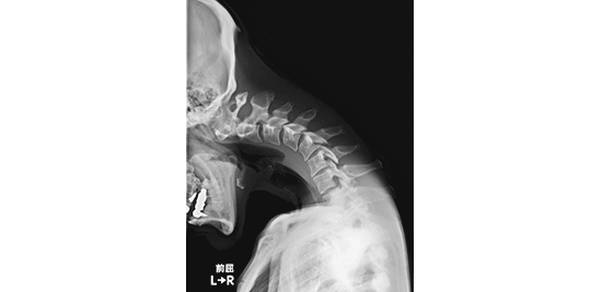 首下がり症を発症した頸椎