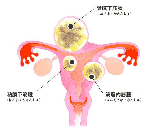 子宮 筋腫 と 子宮 内 膜 症 同時