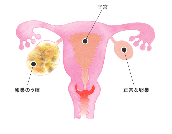 嚢腫 チクチク 卵巣 痛み