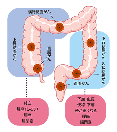 癌 s 状 結腸 TOBYO :