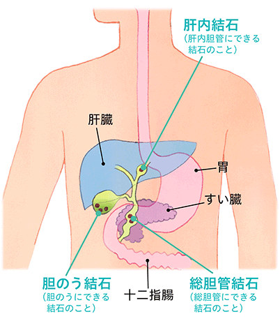 総 胆管 結石