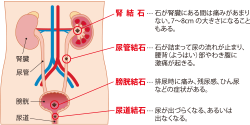 尿路結石ができる場所