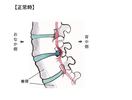 腰椎椎間板ヘルニアの状態：正常時