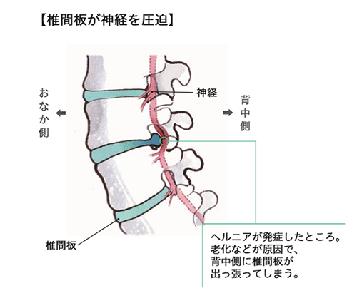 腰椎椎間板ヘルニアの状態：椎間板が神経を圧迫