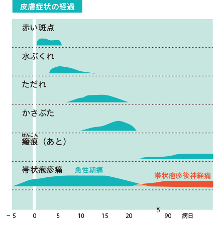 帯状疱疹の症状