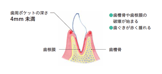 軽度歯周炎