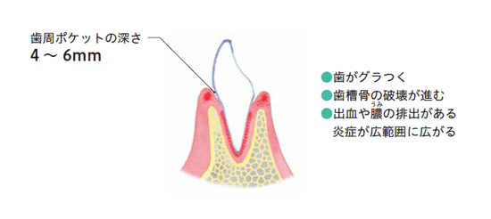 中等度歯周炎