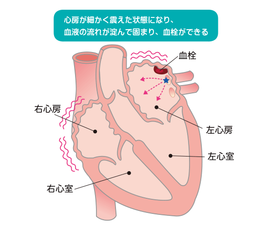 心房細動の症状