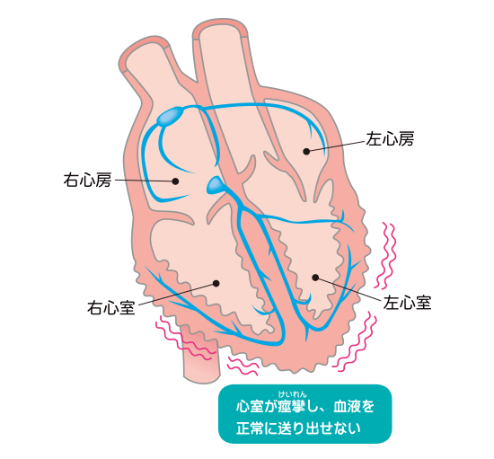 心室細動の症状