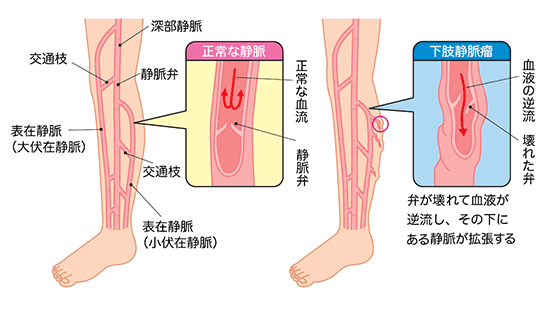 下肢静脈瘤は静脈の弁が壊れることで起きる 