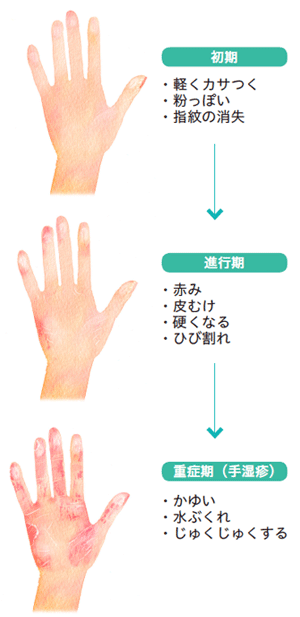 その手荒れ 手湿疹 かも こまめな保湿対策でしっとりスベスベに 知っておきたい病気 医療 からだケアナビ