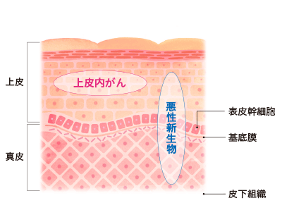 上皮内がんと悪性新生物の違い