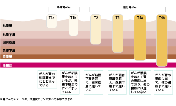 図3 胃がんの深達度とステージ