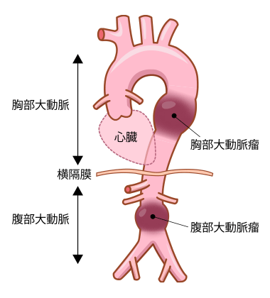 大動脈瘤（胸部動脈瘤と腹部動脈瘤）