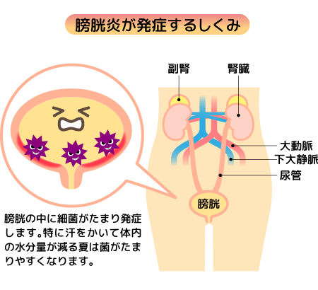 膀胱炎が発症するしくみ