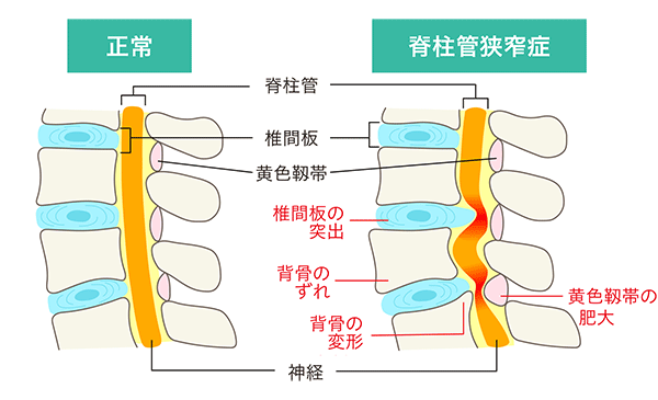 脊柱管の正常な状態と狭窄症の状態