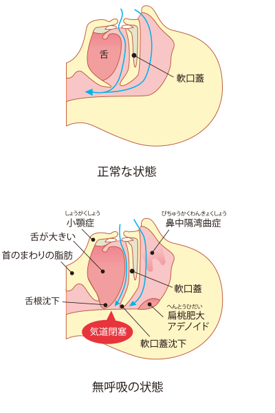 図2　無呼吸が起こる気道の状態