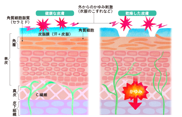 健康な皮膚と乾燥した皮膚におけるかゆみの伝わり方