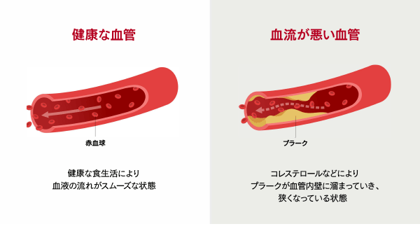 健康な血管と血流が悪い血管のイメージ